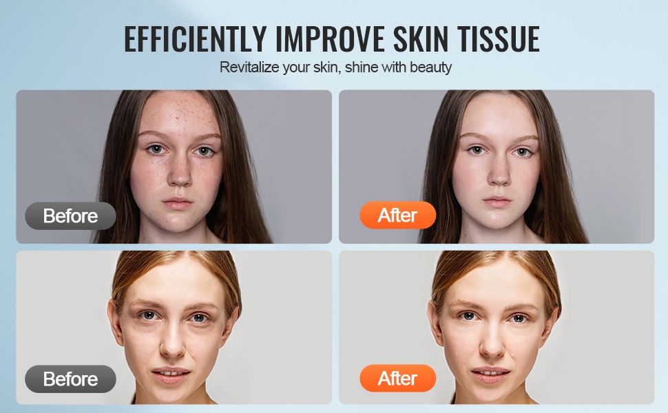 Ihon tekstuurin parantaminen mikroneulauksella